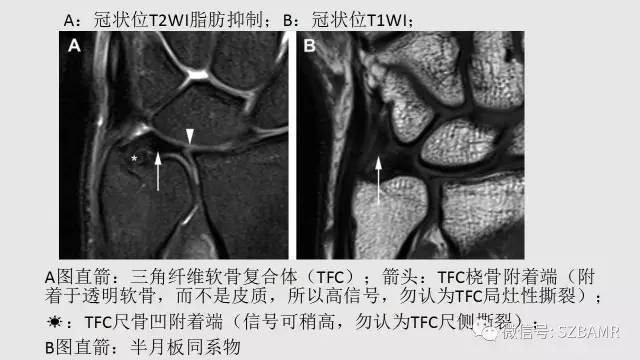 【PPT】腕、手磁共振成像正常解剖与变异