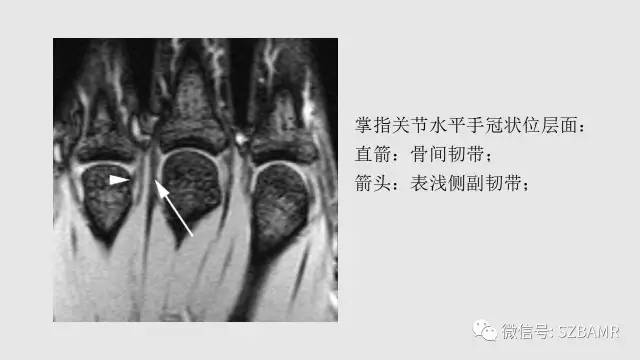 【PPT】腕、手磁共振成像正常解剖与变异