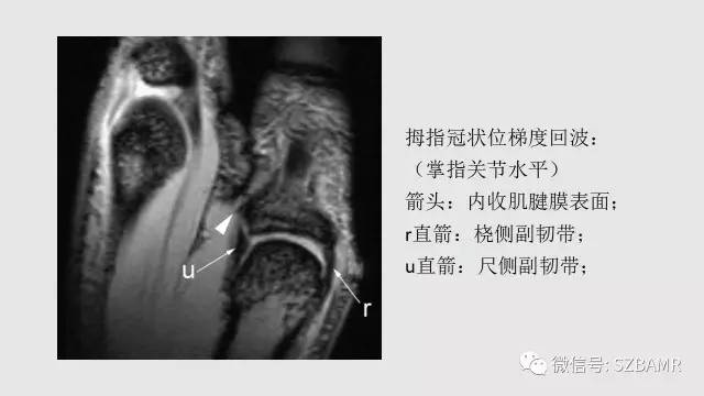 【PPT】腕、手磁共振成像正常解剖与变异