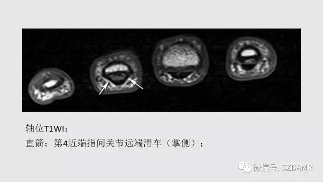 【PPT】腕、手磁共振成像正常解剖与变异