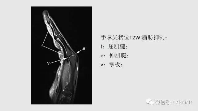 【PPT】腕、手磁共振成像正常解剖与变异