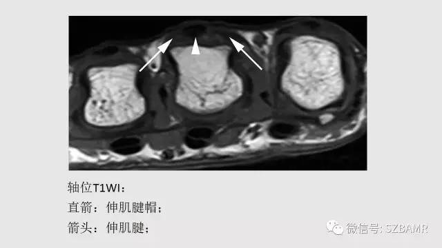 【PPT】腕、手磁共振成像正常解剖与变异