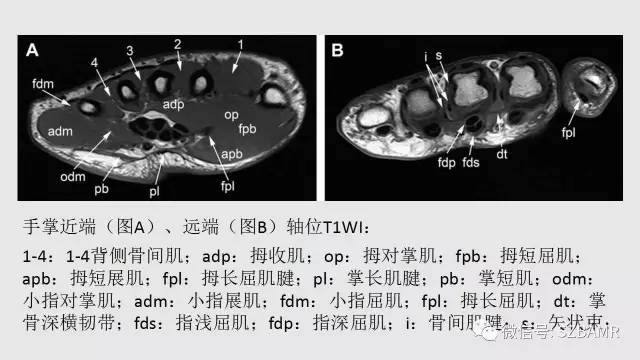 【PPT】腕、手磁共振成像正常解剖与变异