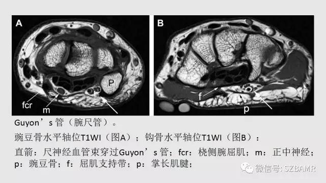 【PPT】腕、手磁共振成像正常解剖与变异