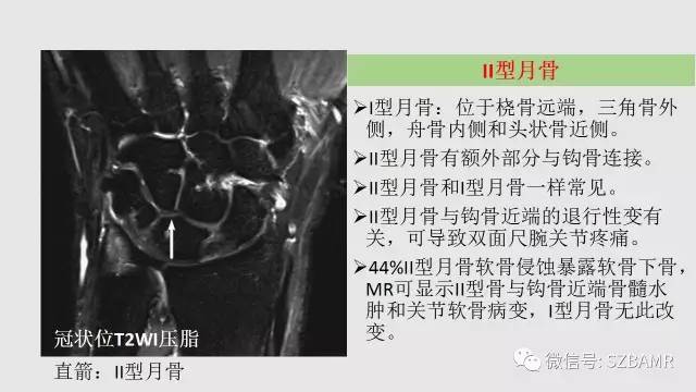 【PPT】腕、手磁共振成像正常解剖与变异