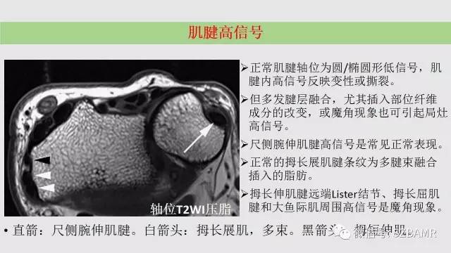 【PPT】腕、手磁共振成像正常解剖与变异