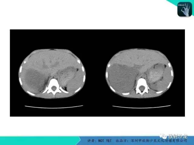 【病例】右肾母细胞瘤1例CT影像表现 【病例】右肾母细胞瘤1例CT影像表现
