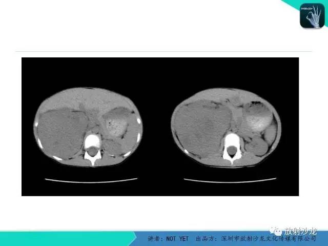 【病例】右肾母细胞瘤1例CT影像表现