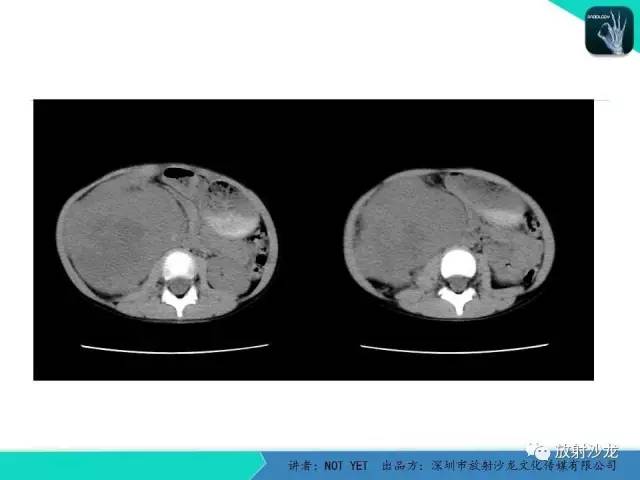 【病例】右肾母细胞瘤1例CT影像表现 【病例】右肾母细胞瘤1例CT影像表现