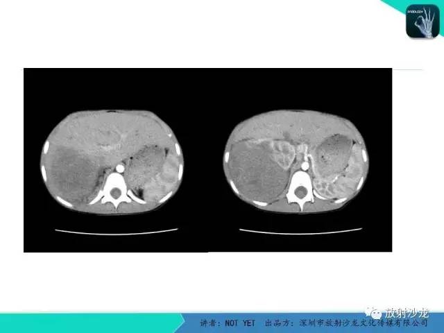 【病例】右肾母细胞瘤1例CT影像表现 【病例】右肾母细胞瘤1例CT影像表现