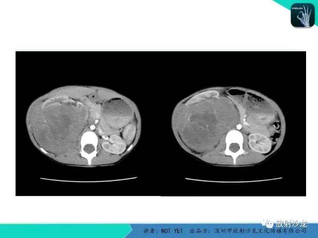【病例】右肾母细胞瘤1例CT影像表现 【病例】右肾母细胞瘤1例CT影像表现