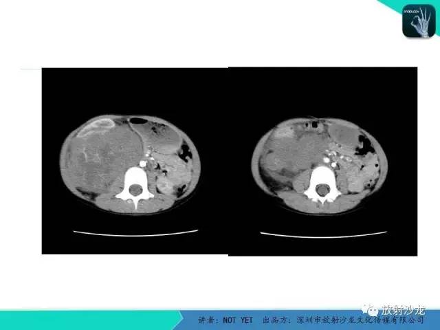 【病例】右肾母细胞瘤1例CT影像表现 【病例】右肾母细胞瘤1例CT影像表现