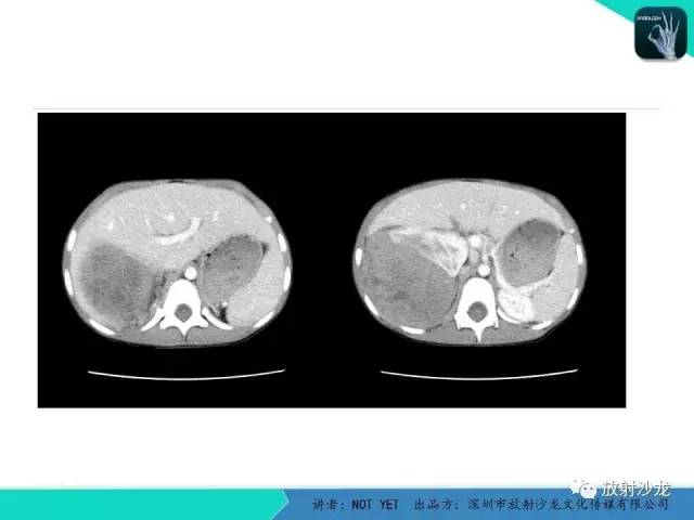 【病例】右肾母细胞瘤1例CT影像表现 【病例】右肾母细胞瘤1例CT影像表现