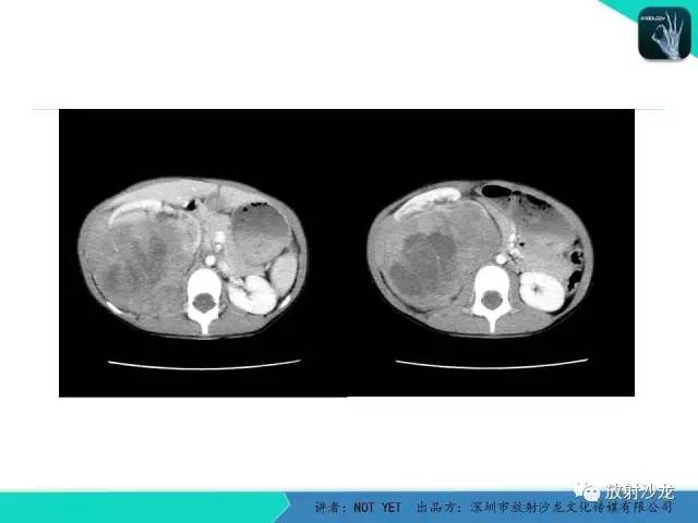 【病例】右肾母细胞瘤1例CT影像表现 【病例】右肾母细胞瘤1例CT影像表现