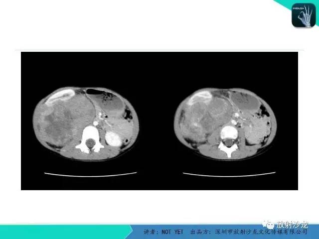 【病例】右肾母细胞瘤1例CT影像表现 【病例】右肾母细胞瘤1例CT影像表现
