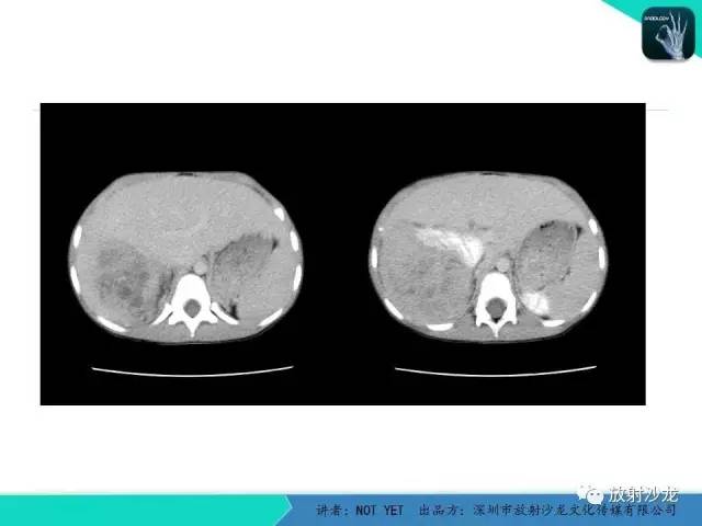 【病例】右肾母细胞瘤1例CT影像表现 【病例】右肾母细胞瘤1例CT影像表现