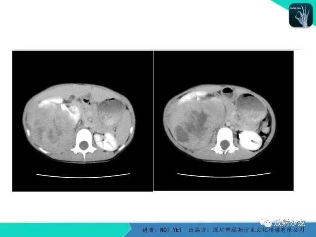 【病例】右肾母细胞瘤1例CT影像表现 【病例】右肾母细胞瘤1例CT影像表现