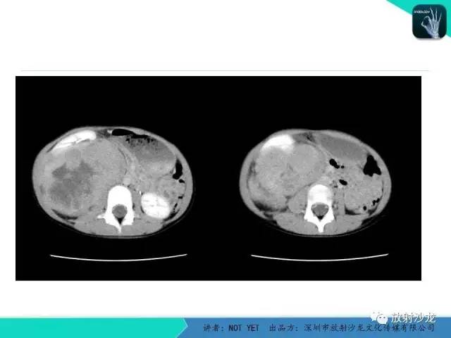 【病例】右肾母细胞瘤1例CT影像表现 【病例】右肾母细胞瘤1例CT影像表现