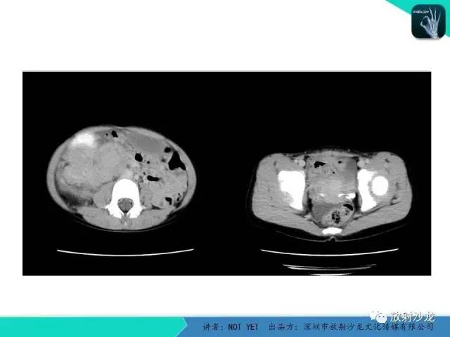 【病例】右肾母细胞瘤1例CT影像表现 【病例】右肾母细胞瘤1例CT影像表现
