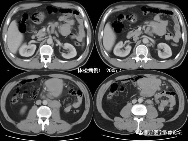 【PPT】 急腹症时的腹腔积气与积液