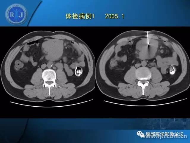 【PPT】 急腹症时的腹腔积气与积液