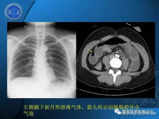 【PPT】 急腹症时的腹腔积气与积液