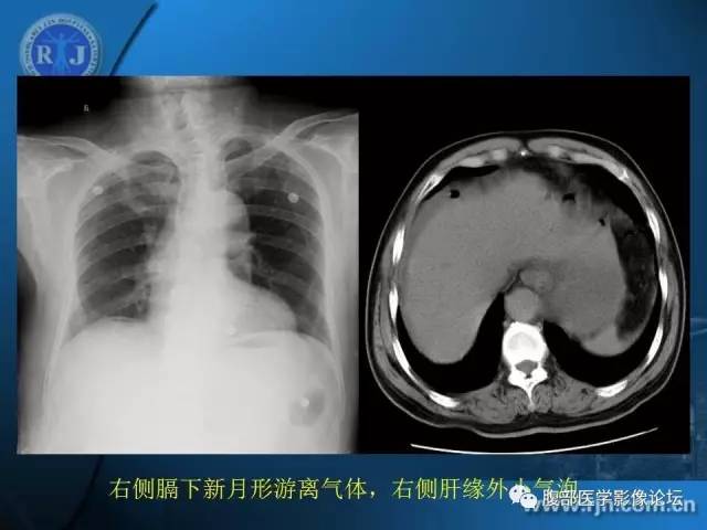 【PPT】 急腹症时的腹腔积气与积液