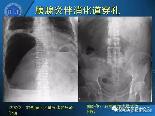 【PPT】 急腹症时的腹腔积气与积液