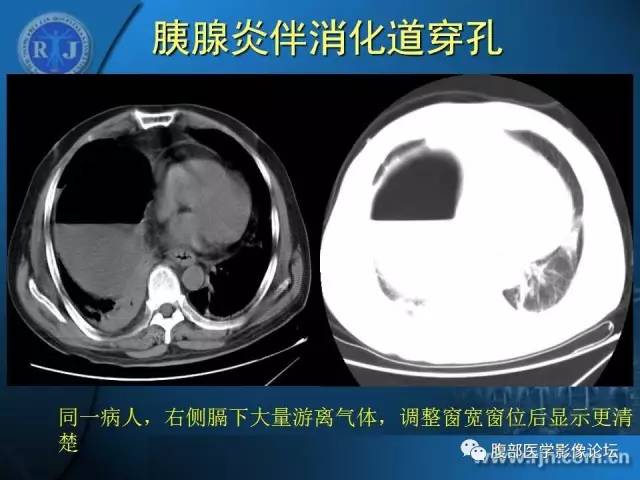 【PPT】 急腹症时的腹腔积气与积液