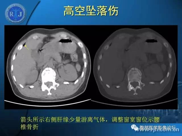 【PPT】 急腹症时的腹腔积气与积液