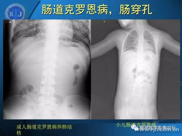 【PPT】 急腹症时的腹腔积气与积液