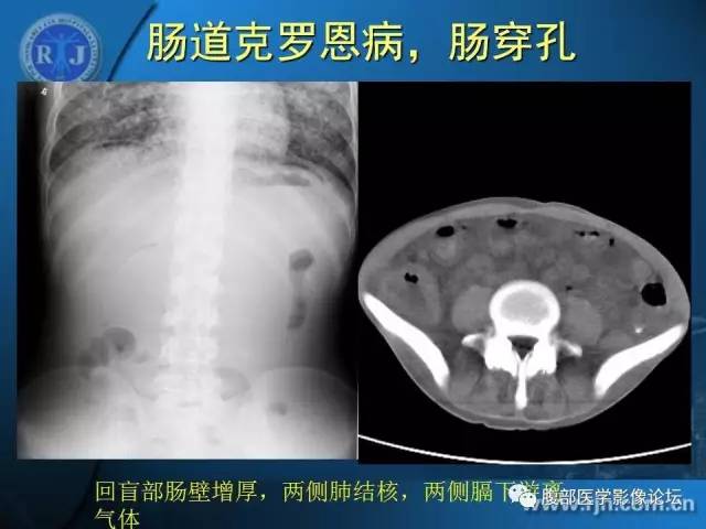 【PPT】 急腹症时的腹腔积气与积液