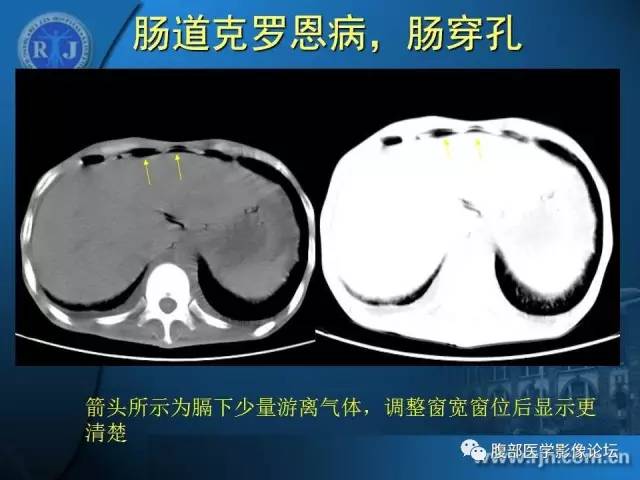 【PPT】 急腹症时的腹腔积气与积液