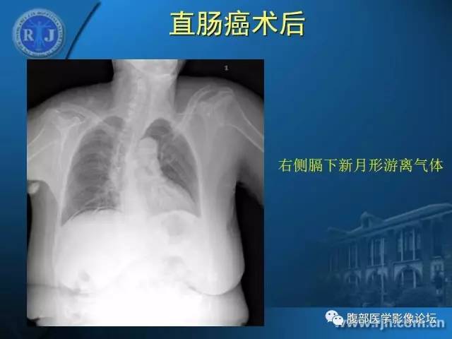 【PPT】 急腹症时的腹腔积气与积液