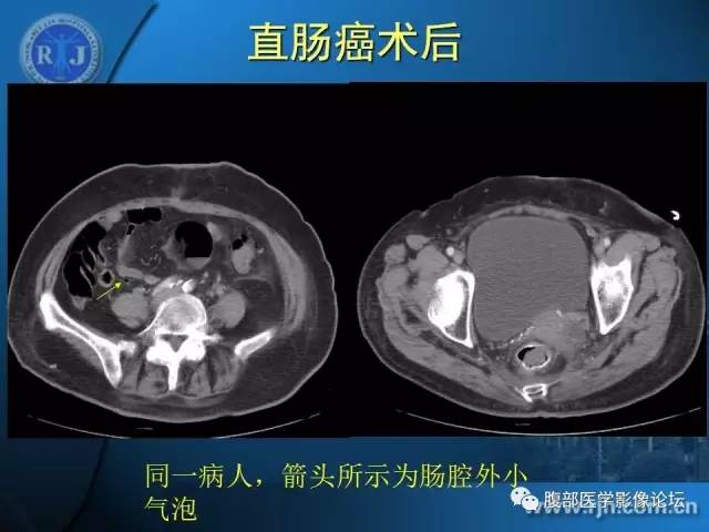 【PPT】 急腹症时的腹腔积气与积液