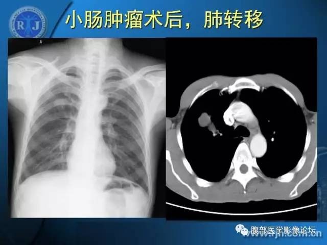 【PPT】 急腹症时的腹腔积气与积液
