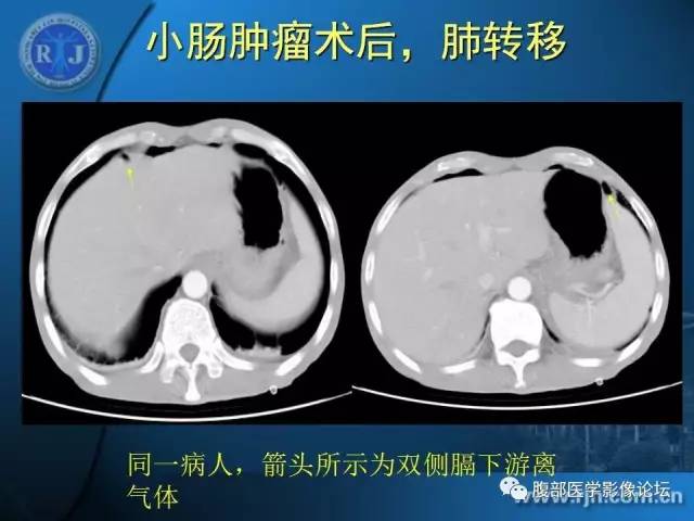 【PPT】 急腹症时的腹腔积气与积液