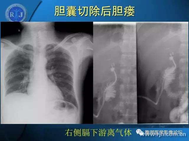 【PPT】 急腹症时的腹腔积气与积液