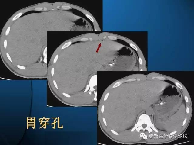 【PPT】 急腹症时的腹腔积气与积液
