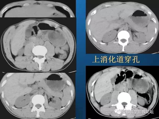 【PPT】 急腹症时的腹腔积气与积液