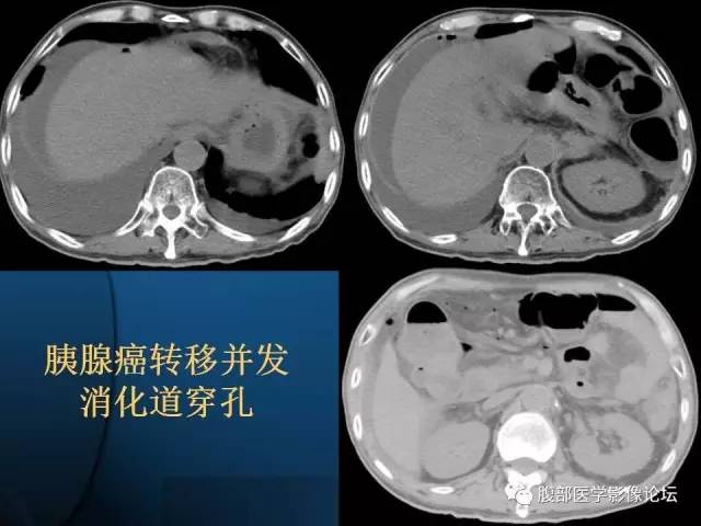 【PPT】 急腹症时的腹腔积气与积液