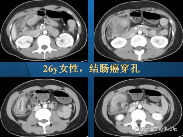 【PPT】 急腹症时的腹腔积气与积液