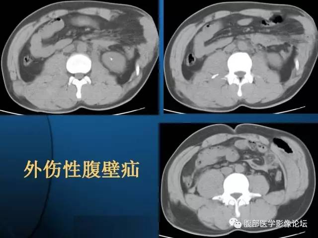 【PPT】 急腹症时的腹腔积气与积液