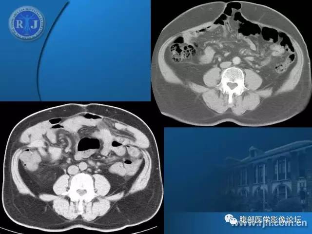 【PPT】 急腹症时的腹腔积气与积液