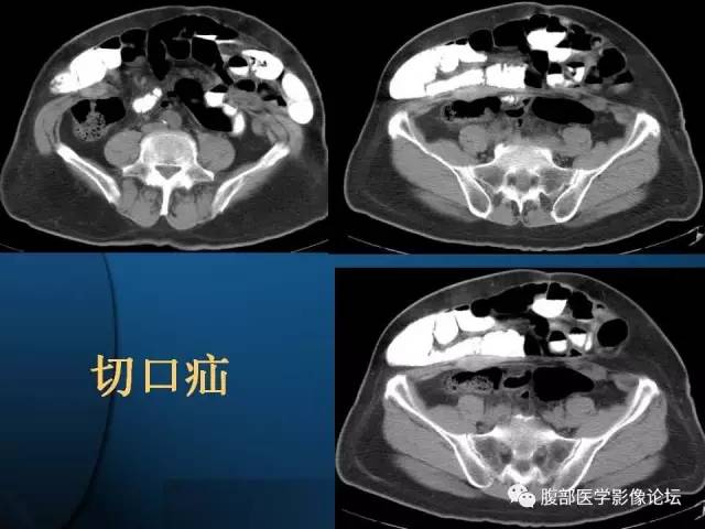【PPT】 急腹症时的腹腔积气与积液