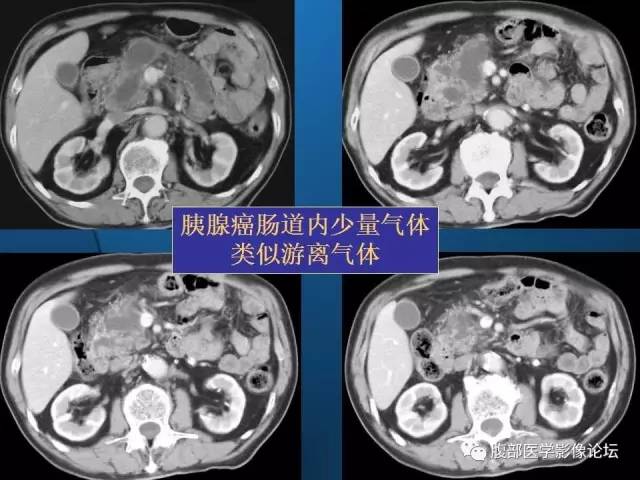 【PPT】 急腹症时的腹腔积气与积液