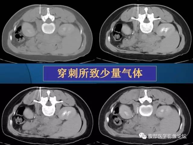 【PPT】 急腹症时的腹腔积气与积液