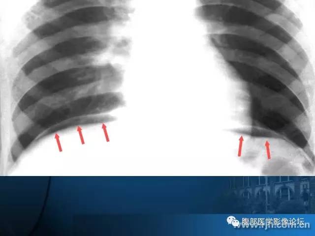 【PPT】 急腹症时的腹腔积气与积液