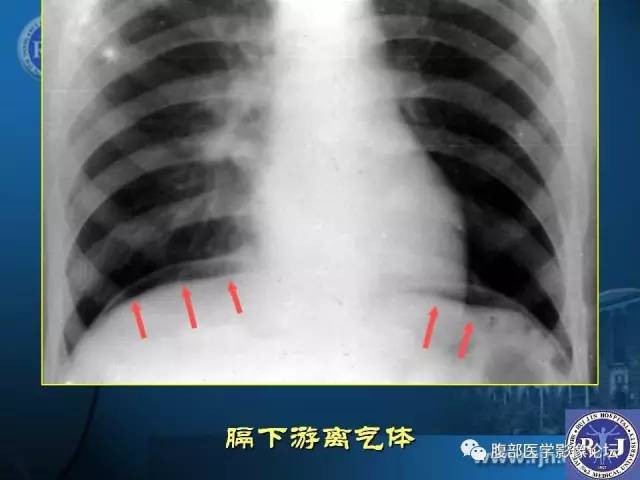 【PPT】 急腹症时的腹腔积气与积液