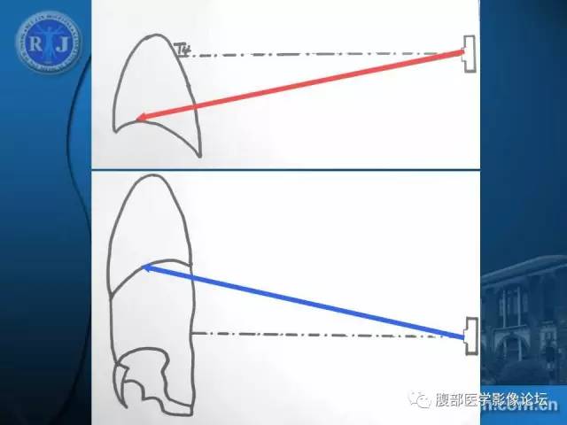 【PPT】 急腹症时的腹腔积气与积液